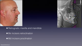 ©sylvainchamberland.com
•Retrognatic maxilla and mandible
•Mx incisors retroclination
•Md incisors proclination
 