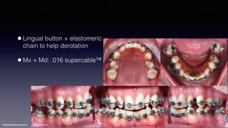 ©sylvainchamberland.com
•Lingual button + elastomeric
chain to help derotation
•Mx + Md: .016 supercable™
ClPe120612
 