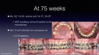 ©sylvainchamberland.com
At 75 weeks
•Mx: EC 14-24. active coil 14-17, 24-27.
✓ ART auxilliary since 6 weeks to be
maintained
•Md: 21x21x20x58 mm enmasse ret
✓ Cl III elastics
ClPe201113
 