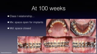 ©sylvainchamberland.com
At 100 weeks
•Class I relationship…
•Mx: space open for implants
•Md: space closed
ClPe140514
 