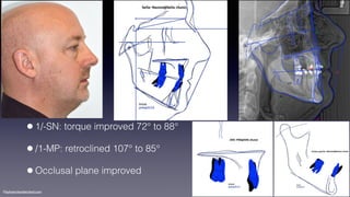 ©sylvainchamberland.com
•1/-SN: torque improved 72° to 88°
•/1-MP: retroclined 107° to 85°
•Occlusal plane improved
 
