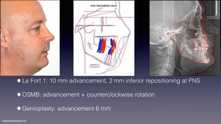 ©sylvainchamberland.com
•Le Fort 1: 10 mm advancement, 2 mm inferior repositioning at PNS
•OSMB: advancement + counterclockwise rotation
•Genioplasty: advancement 6 mm
 