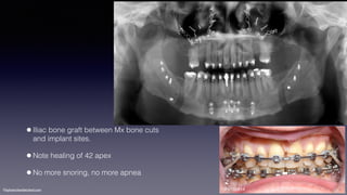 ©sylvainchamberland.com
•Iliac bone graft between Mx bone cuts  
and implant sites.
•Note healing of 42 apex
•No more snoring, no more apnea
ClPe160914
 