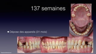 ©sylvainchamberland.com
137 semaines
•Dépose des appareils (31 mois)
ClPe260115
 