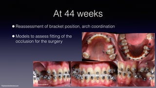 ©sylvainchamberland.com
At 44 weeks
•Reassessment of bracket position, arch coordination
•Models to assess ﬁtting of the  
occlusion for the surgery
HeAr050810
 