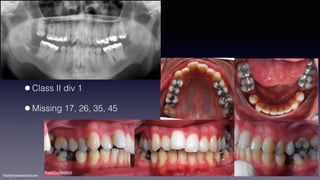 ©sylvainchamberland.com
•Class II div 1
•Missing 17, 26, 35, 45
KeBiDu080609
 