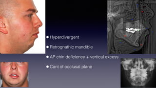 ©sylvainchamberland.com
•Hyperdivergent
•Retrognathic mandible
•AP chin deﬁciency + vertical excess
•Cant of occlusal plane
 