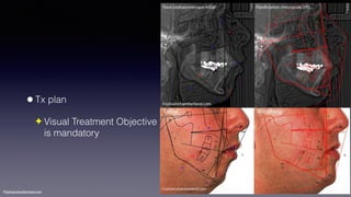 ©sylvainchamberland.com
•Tx plan
✦ Visual Treatment Objective 
is mandatory
 
