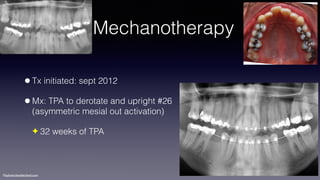 ©sylvainchamberland.com
Mechanotherapy
•Tx initiated: sept 2012
•Mx: TPA to derotate and upright #26  
(asymmetric mesial out activation)
✦ 32 weeks of TPA
 