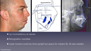 ©sylvainchamberland.com
•Lip incompetency at repose
•Retrognathic mandible
•Lower incisors could be more upright but space for implant 35, 45 was needed
 