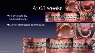 ©sylvainchamberland.com
At 68 weeks
•Prior to surgery  
(planned in April)
•Dental arches are coordinated
HeAr050810
HeAr170111
 