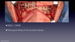 ©sylvainchamberland.com
•BSSO / OSMB
•Note good ﬁtting of the occlusion perop
 