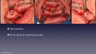 ©sylvainchamberland.com
•Genioplasty
•Bone graft at edentulous site
 