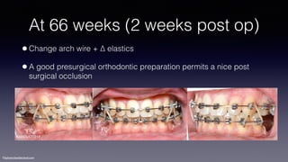 ©sylvainchamberland.com
At 66 weeks (2 weeks post op)
•Change arch wire + ∆ elastics
•A good presurgical orthodontic preparation permits a nice post
surgical occlusion
KeBiDu171213
 