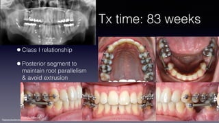©sylvainchamberland.com
Tx time: 83 weeks
•Class I relationship
•Posterior segment to
maintain root parallelism 
& avoid extrusion
KeBiDu300414
 