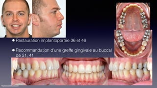©sylvainchamberland.com
•Restauration implantoportée 36 et 46
•Recommandation d’une greffe gingivale au buccal
de 31, 41
KeBiDu181214
 