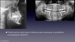 ©sylvainchamberland.com
•Proéminence radiculaire inférieure peut expliquer le problème
mucogingival observé
 