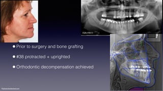 ©sylvainchamberland.com
•Prior to surgery and bone grafting
•#38 protracted + uprighted
•Orthodontic decompensation achieved
HeAr170111
 