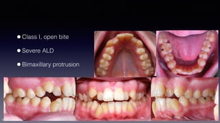 ©sylvainchamberland.com
•Class I, open bite
•Severe ALD
•Bimaxillary protrusion
PaPl150512
 