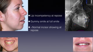 ©sylvainchamberland.com
•Lip incompetency at repose
•Gummy smile at full smile
•~Normal incisor showing at
repose
 