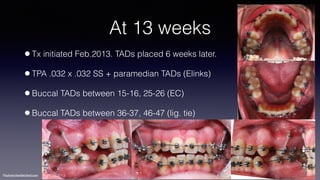 ©sylvainchamberland.com
At 13 weeks
•Tx initiated Feb.2013. TADs placed 6 weeks later.
•TPA .032 x .032 SS + paramedian TADs (Elinks)
•Buccal TADs between 15-16, 25-26 (EC)
•Buccal TADs between 36-37, 46-47 (lig. tie)
PaPl 160513
 
