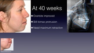 ©sylvainchamberland.com
At 40 weeks
•Overbite improved
•Still bimax protrusion
•Need maximum retraction
Initial
PaPl 211113
 