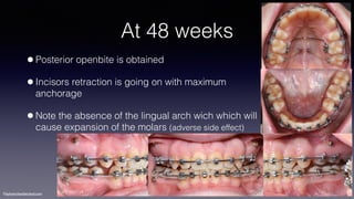 ©sylvainchamberland.com
At 48 weeks
•Posterior openbite is obtained
•Incisors retraction is going on with maximum
anchorage
•Note the absence of the lingual arch wich which will
cause expansion of the molars (adverse side effect)
PaPl 160114
 