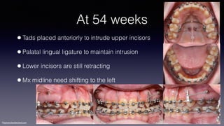 ©sylvainchamberland.com
At 54 weeks
•Tads placed anteriorly to intrude upper incisors
•Palatal lingual ligature to maintain intrusion
•Lower incisors are still retracting
•Mx midline need shifting to the left
PaPl 270214
 