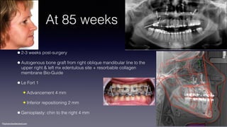 ©sylvainchamberland.com
At 85 weeks
•2-3 weeks post-surgery
•Autogenous bone graft from right oblique mandibular line to the
upper right & left mx edentulous site + resorbable collagen  
membrane Bio-Guide
•Le Fort 1
✦ Advancement 4 mm
✦ Inferior repositioning 2 mm
•Genioplasty: chin to the right 4 mm
HeAr160511
 