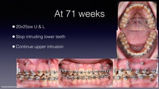 ©sylvainchamberland.com
At 71 weeks
•20x25sw U & L
•Stop intruding lower teeth
•Continue upper intrusion
PaPl 230614
 