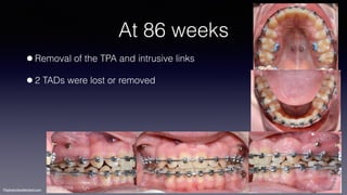 ©sylvainchamberland.com
At 86 weeks
•Removal of the TPA and intrusive links
•2 TADs were lost or removed
PaPl 091014
 