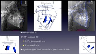 ©sylvainchamberland.com
•FMA decrease 4°
•/1-MP decrease 10°
✦ /1-APg decreased 3 mm
✦ /1 intrusion 2 mm
•Signiﬁcant upper molar intrusion & upper incisor intrusion
 
