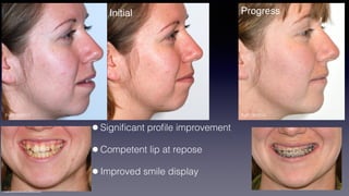 ©sylvainchamberland.com
•Signiﬁcant proﬁle improvement
•Competent lip at repose
•Improved smile display
PaPl 150512
Initial
PaPl 091014
Progress
 