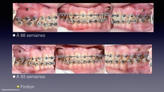©sylvainchamberland.com
•À 88 semaines 
 
 
 
 
 
•À 93 semaines
✦ Finition
PaPl080115
PaPl151214
 