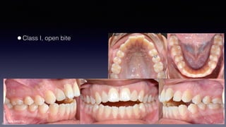 ©sylvainchamberland.com
•Class I, open bite
LiNda 040214
 