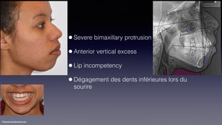 ©sylvainchamberland.com
•Severe bimaxillary protrusion
•Anterior vertical excess
•Lip incompetency
•Dégagement des dents inférieures lors du
sourire
 