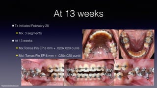 ©sylvainchamberland.com
At 13 weeks
•Tx initiated February 25
✦ Mx: 3 segments
•At 13 weeks
✦ Mx:Tomas Pin EP 8 mm + .020x.020 cuniti
✦ Md: Tomas Pin EP 6 mm + .020x.020 cuniti
LiNda 270514
 