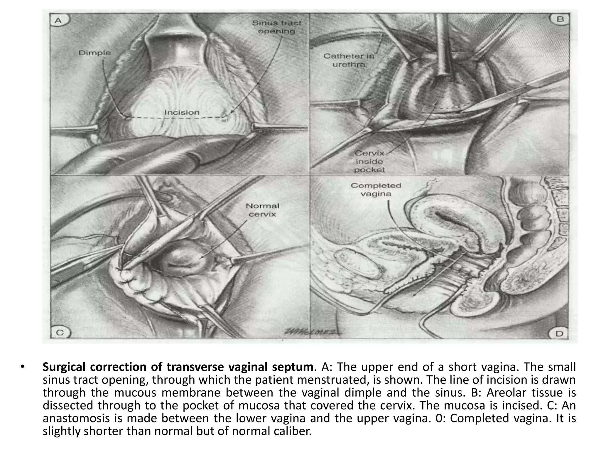 • Surgical correction of transverse vaginal septum. A: The upper end of a short vagina. The small 
sinus tract opening, through which the patient menstruated, is shown. The line of incision is drawn 
through the mucous membrane between the vaginal dimple and the sinus. B: Areolar tissue is 
dissected through to the pocket of mucosa that covered the cervix. The mucosa is incised. C: An 
anastomosis is made between the lower vagina and the upper vagina. 0: Completed vagina. It is 
slightly shorter than normal but of normal caliber. 
 