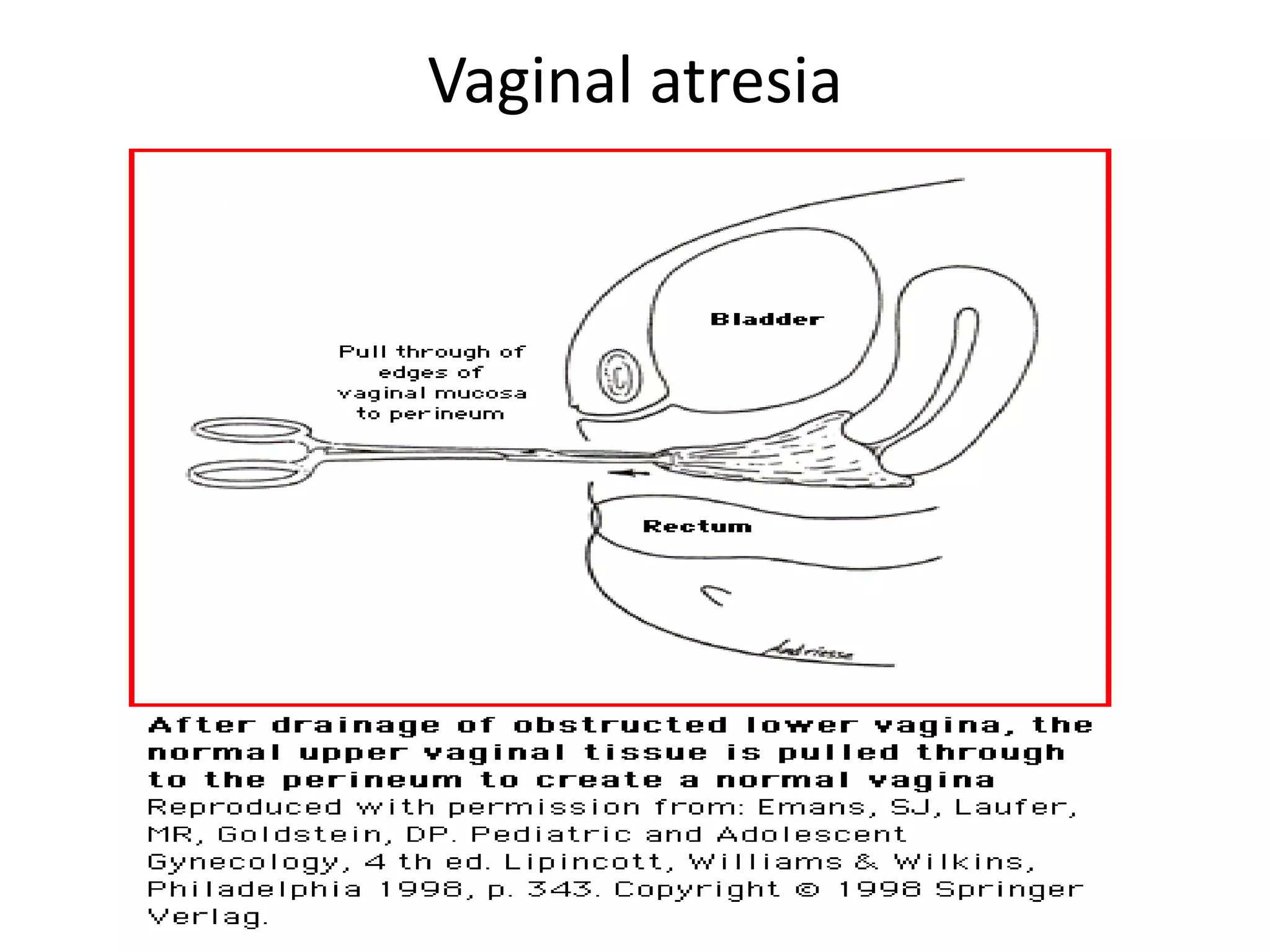 Vaginal atresia 
 