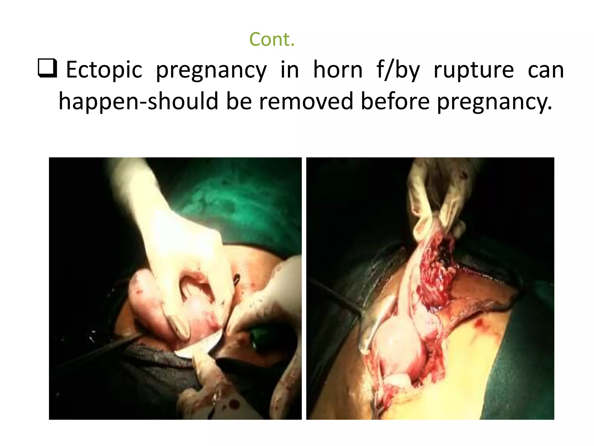 Cont. 
 Ectopic pregnancy in horn f/by rupture can 
happen-should be removed before pregnancy. 
 