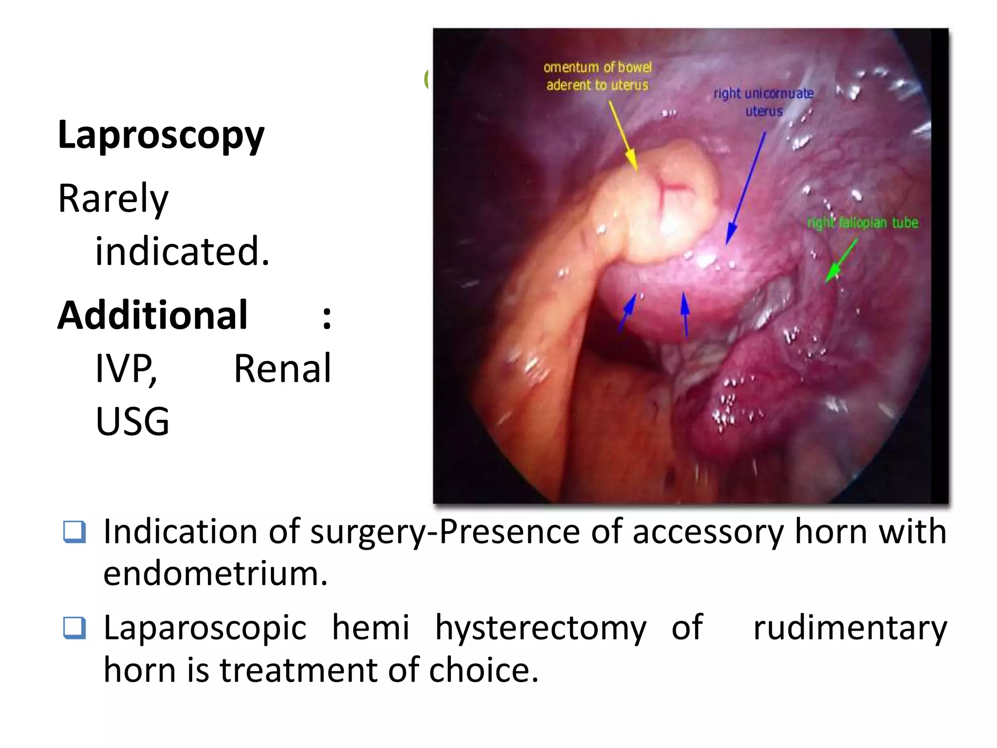 Cont 
Laproscopy 
Rarely 
indicated. 
Additional : 
IVP, Renal 
USG 
 Indication of surgery-Presence of accessory horn with 
endometrium. 
 Laparoscopic hemi hysterectomy of rudimentary 
horn is treatment of choice. 
 