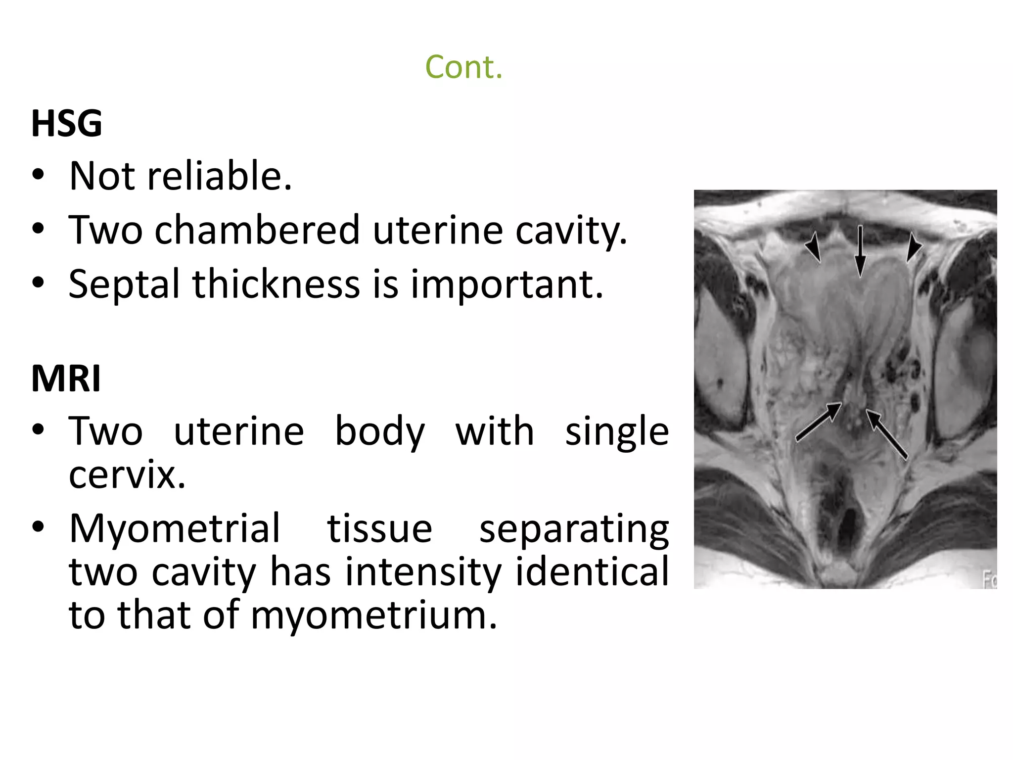 Cont. 
HSG 
• Not reliable. 
• Two chambered uterine cavity. 
• Septal thickness is important. 
MRI 
• Two uterine body with single 
cervix. 
• Myometrial tissue separating 
two cavity has intensity identical 
to that of myometrium. 
 