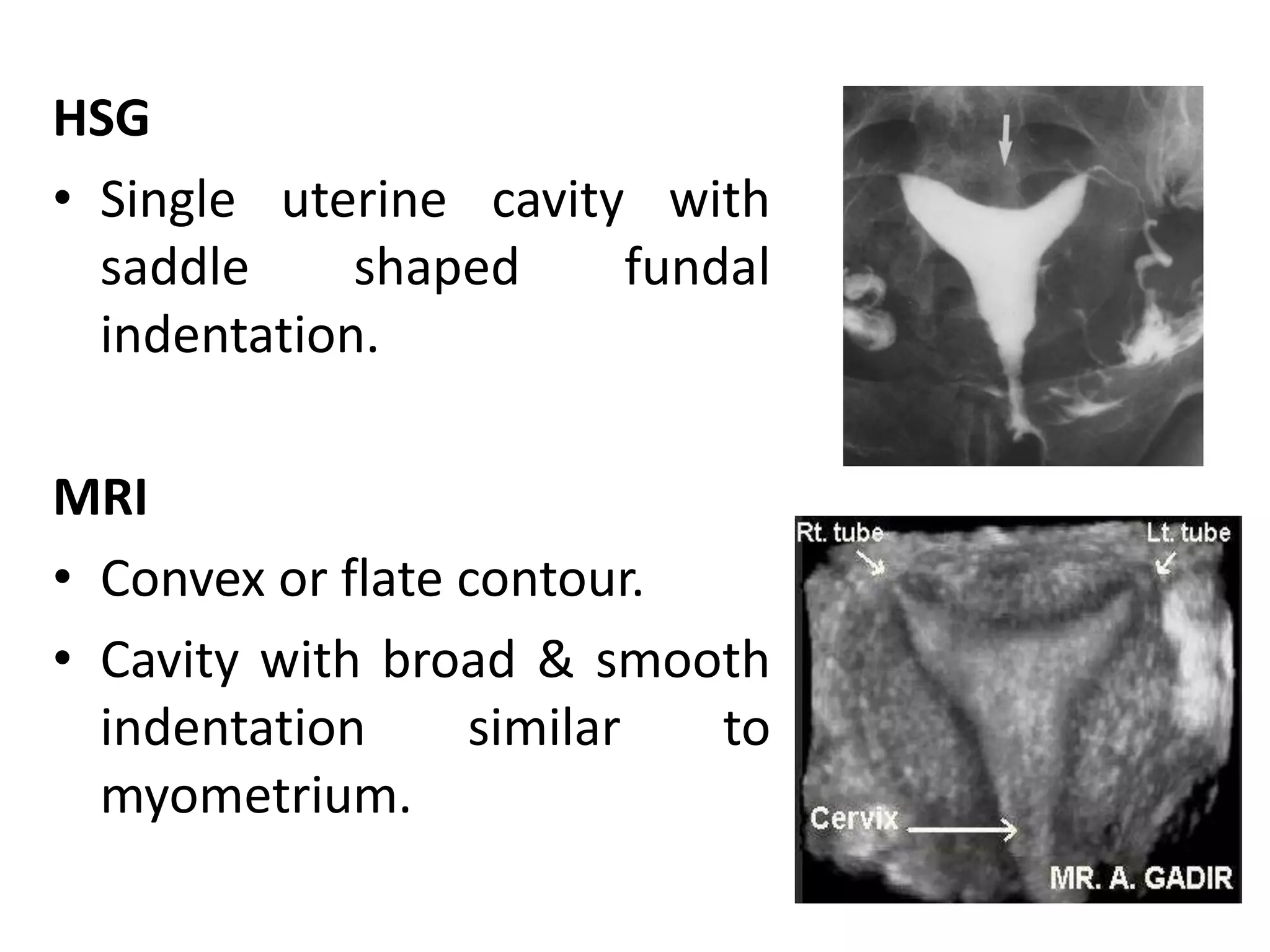 HSG 
• Single uterine cavity with 
saddle shaped fundal 
indentation. 
MRI 
• Convex or flate contour. 
• Cavity with broad & smooth 
indentation similar to 
myometrium. 
 
