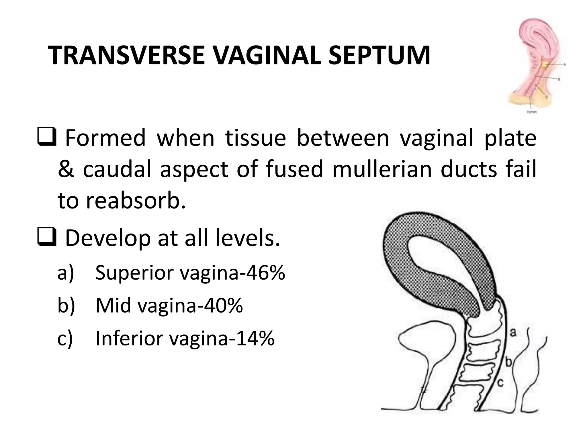 TRANSVERSE VAGINAL SEPTUM 
 Formed when tissue between vaginal plate 
& caudal aspect of fused mullerian ducts fail 
to reabsorb. 
 Develop at all levels. 
a) Superior vagina-46% 
b) Mid vagina-40% 
c) Inferior vagina-14% 
 