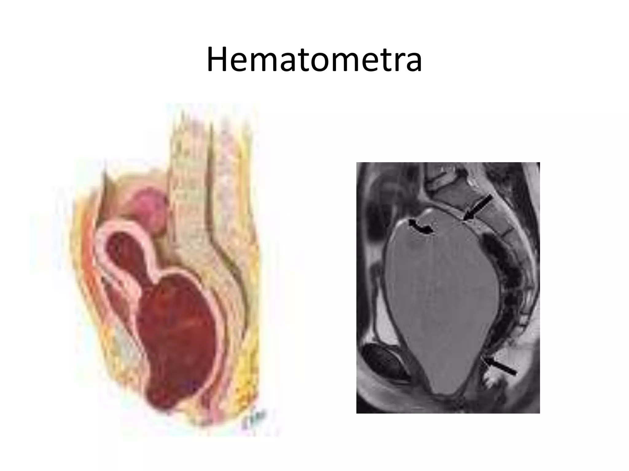 Hematometra 
 