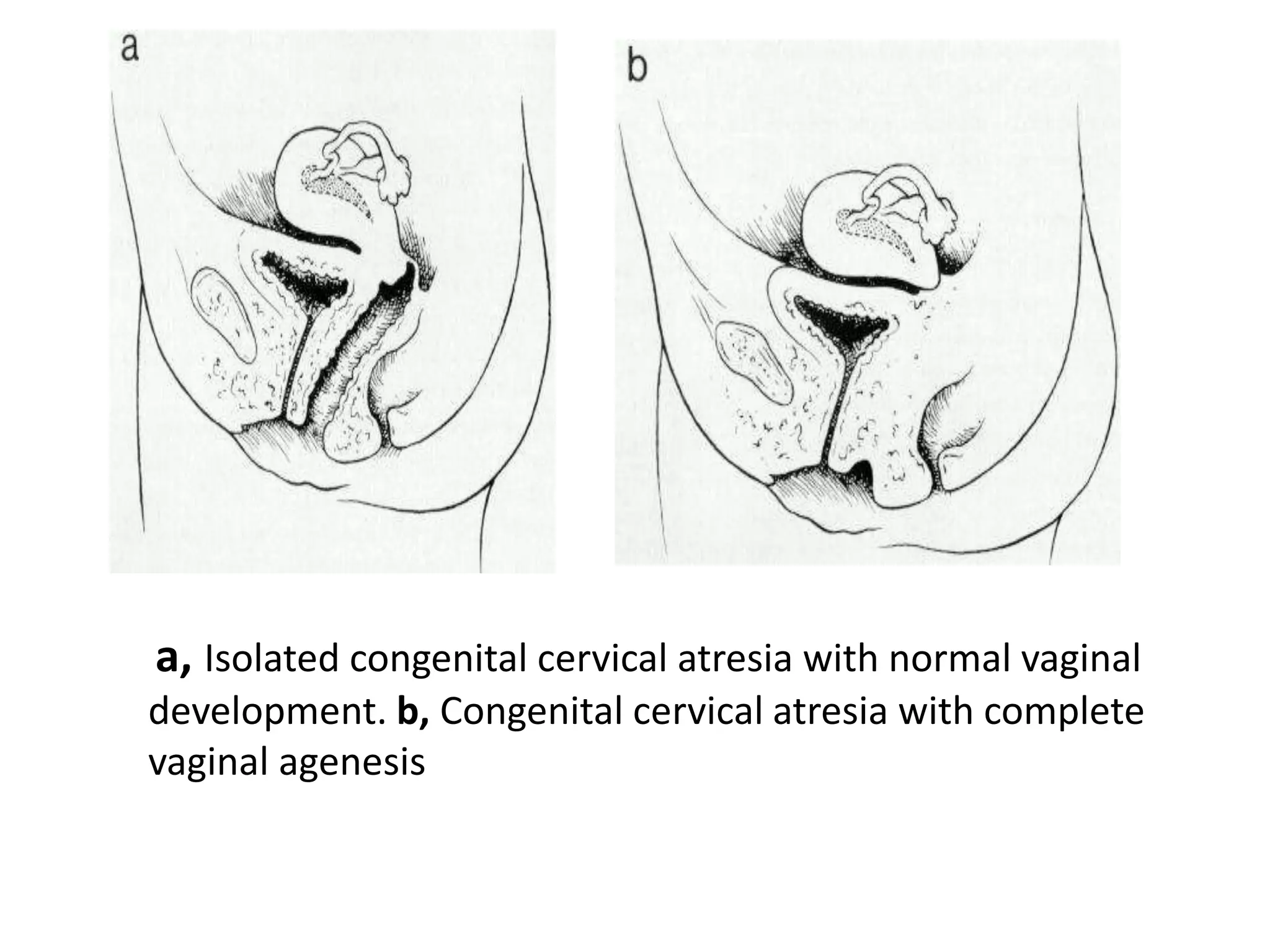 a, Isolated congenital cervical atresia with normal vaginal 
development. b, Congenital cervical atresia with complete 
vaginal agenesis 
 
