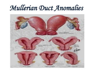 Mullerian Duct Anomalies 
 