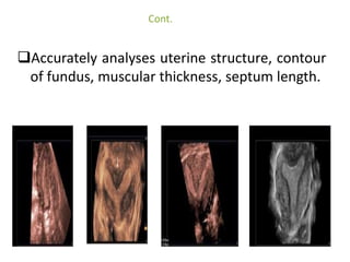 Cont. 
Unicoruate uterus- 
• Banana or cigar shaped uterine cavity. 
• Laterally deviated. 
• Preserved zonal anatomy. 
•...