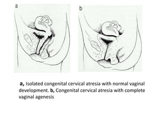 EFFECTS OF ABNORMALITY ON PREGNANCY: 
•When pregnancy occurs in the woman with an abnormal uterus, the 
outcome depends on...