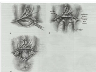 UTERUS DIDELPHYS 
Uterus didelphys with obstructed unilateral 
vagina- Full excision and marsupalization of 
vaginal sept...